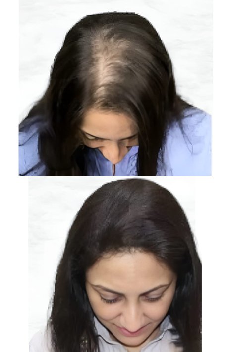 hair-transplant-in-females-service