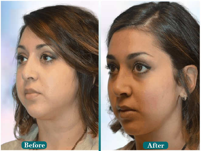 Corrective-hair-transplant