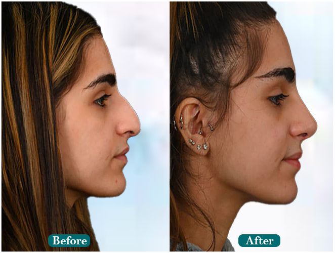 Male-hair-transplant