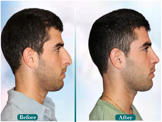 Corrective-hair-transplant