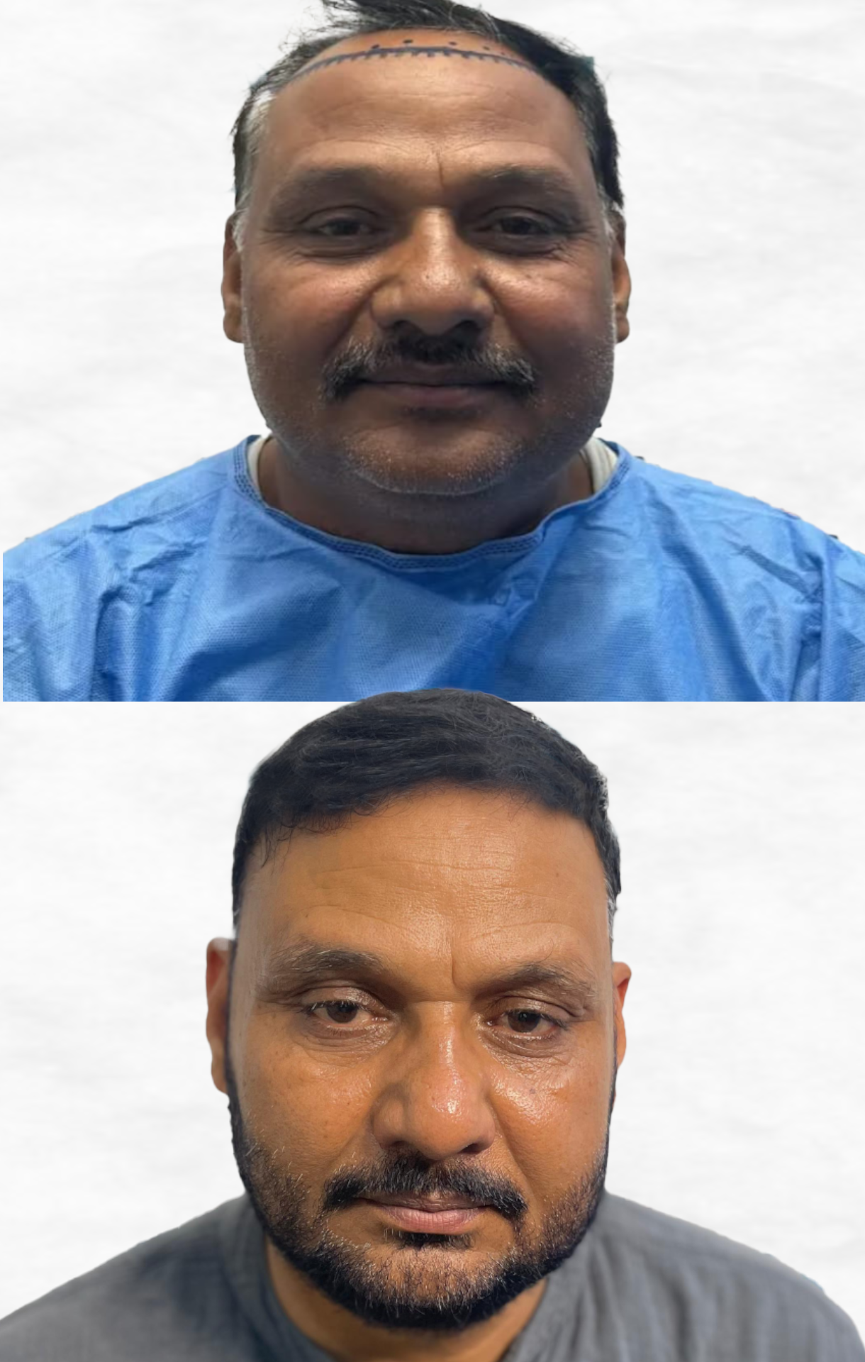shami-hair-transplant-latest